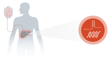 An illustration of CRISPR-based gene editing being infused into the liver
