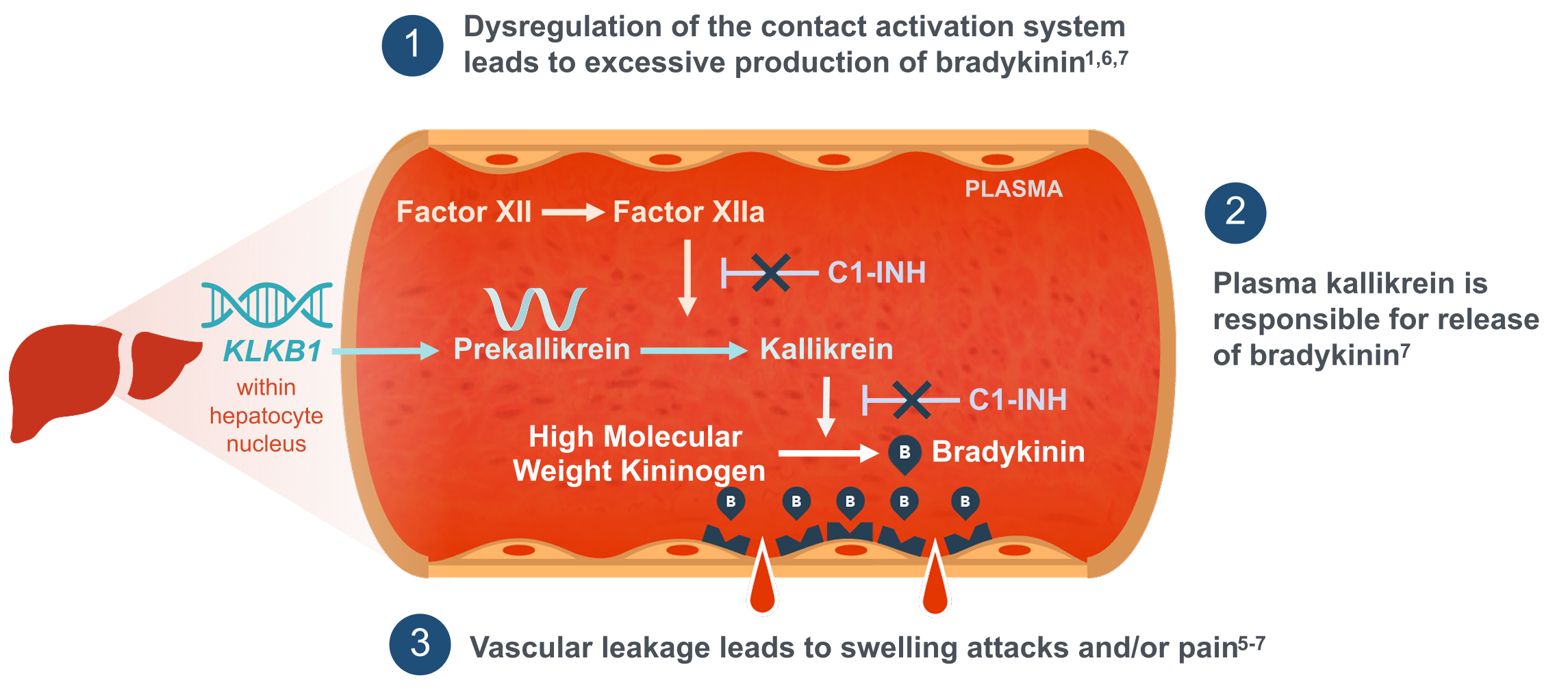 An illustration showing hereditary angioedema (HAE)